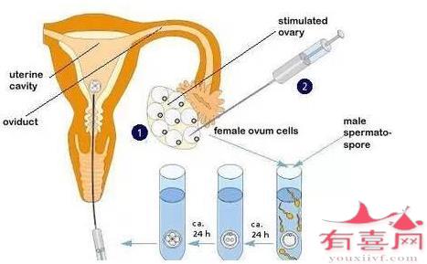 湖北红房子妇科医院做借卵试管婴儿成功率