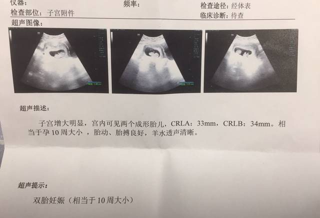 供卵试管没成功自然怀孕了