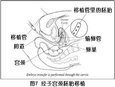 试管是不是一定要做宫腔镜