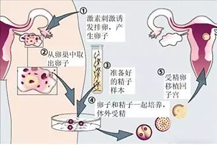 借卵试管代怀产子短方案能取多少卵+微刺激方案当月移植吗